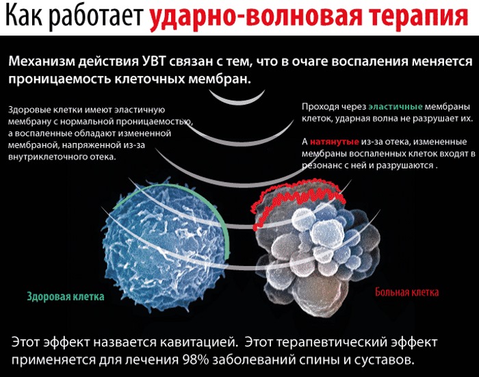 Ударно-волновая терапия в санатории им. академика И. П. Павлова